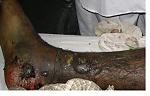 snake-first-aid-saw-scaled-viper-bite-small.jpg